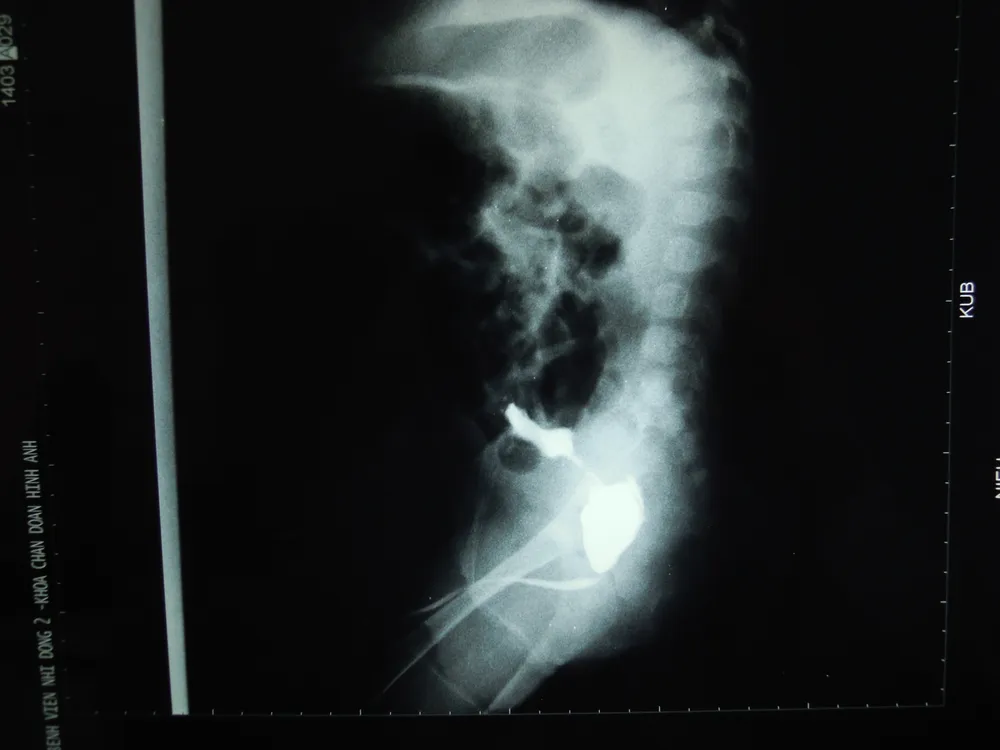 Trẻ bị vỡ bàng quang do dị tật niệu ảnh 1